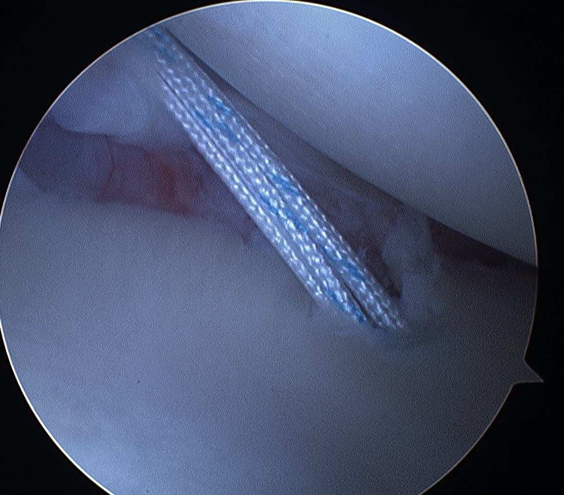 Inferior Glenoid Anchor